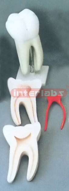 GIANT CARIES MOLAR. 3 PCS / SET.